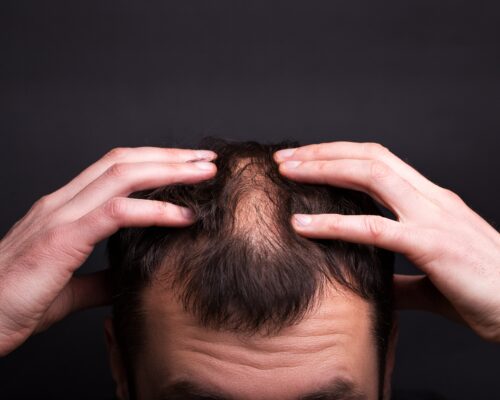 HAIR TRANSPLANT AND TREATMENTS